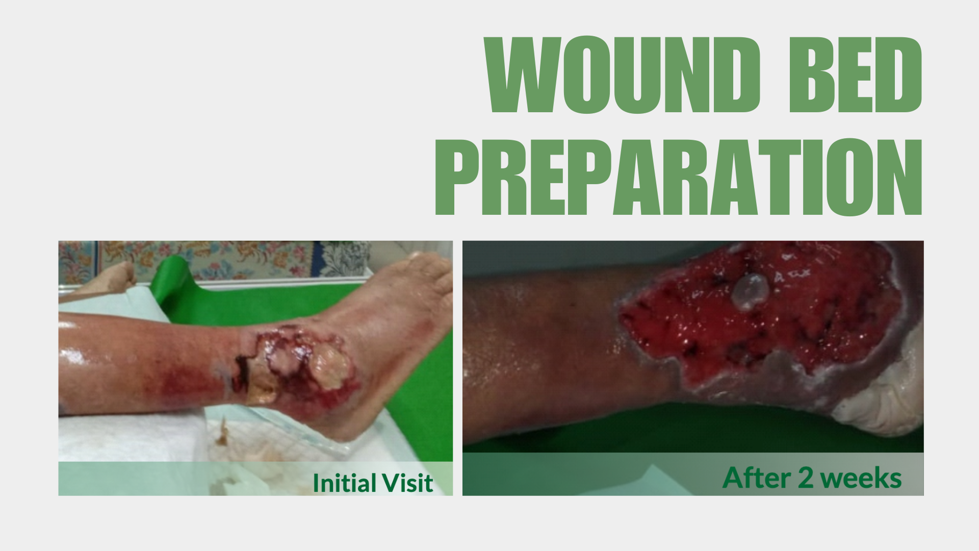 Two weeks challenge of wound bed preparation: A Metcovazin Reguler® case study as primary dressing
