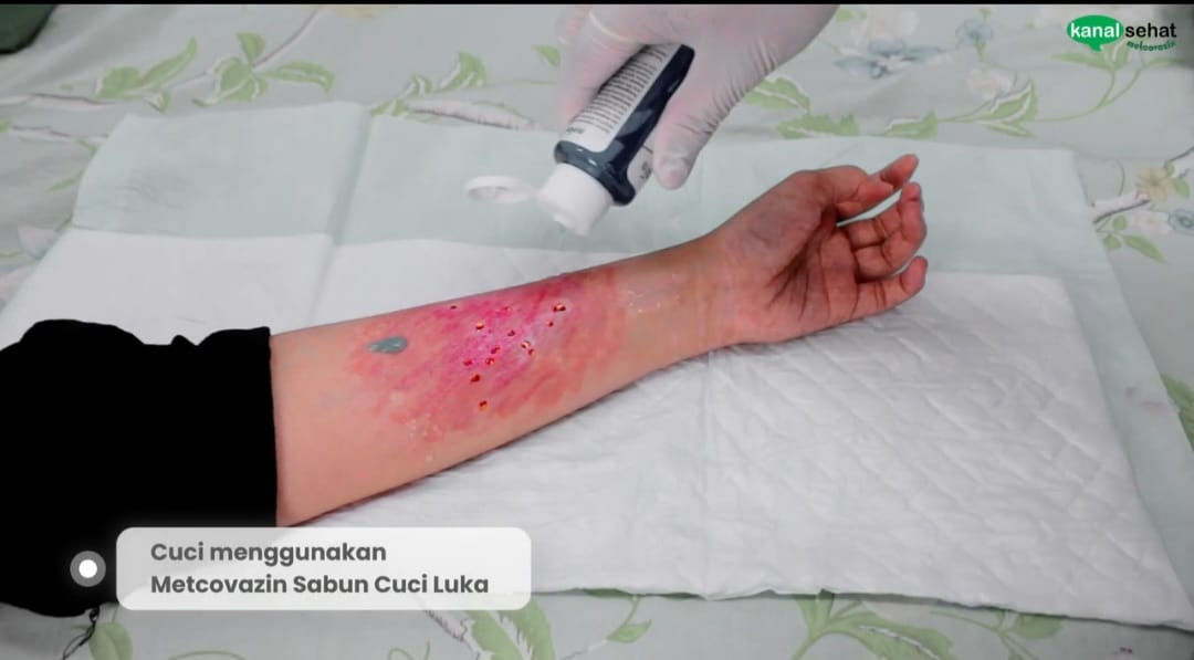 Langkah 1: Mencuci Luka