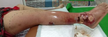 Two weeks challenge of wound bed ® preparation: A Metcovazin Reguler case study as primary dressing